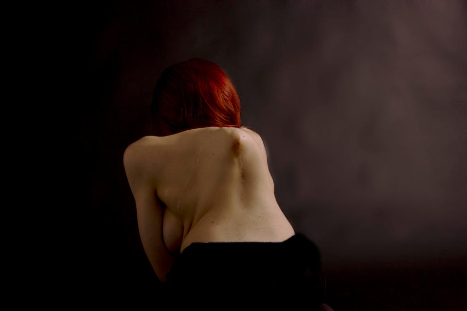 Becky Dann of The Undateables models in her photography project 'I'm fine' showing her curved spine due to scoliosis.